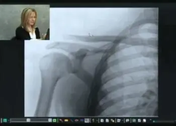 A Witness using smartboard to annotate X-ray during interactive deposition in Philadelphia personal injury case.