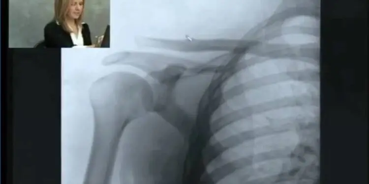 A Witness using smartboard to annotate X-ray during interactive deposition in Philadelphia personal injury case.